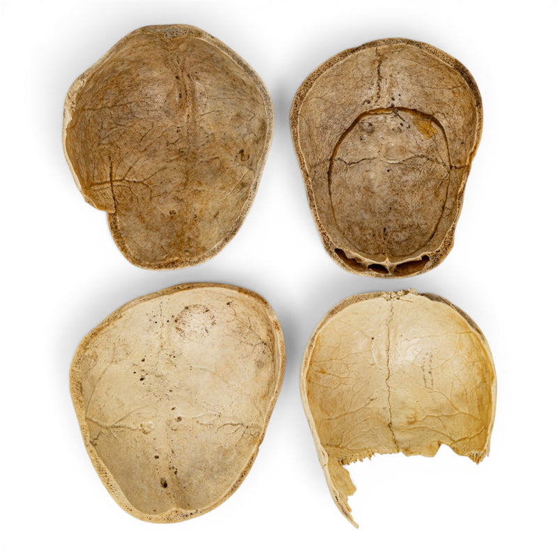 <p>The top dome part of the cranium</p>