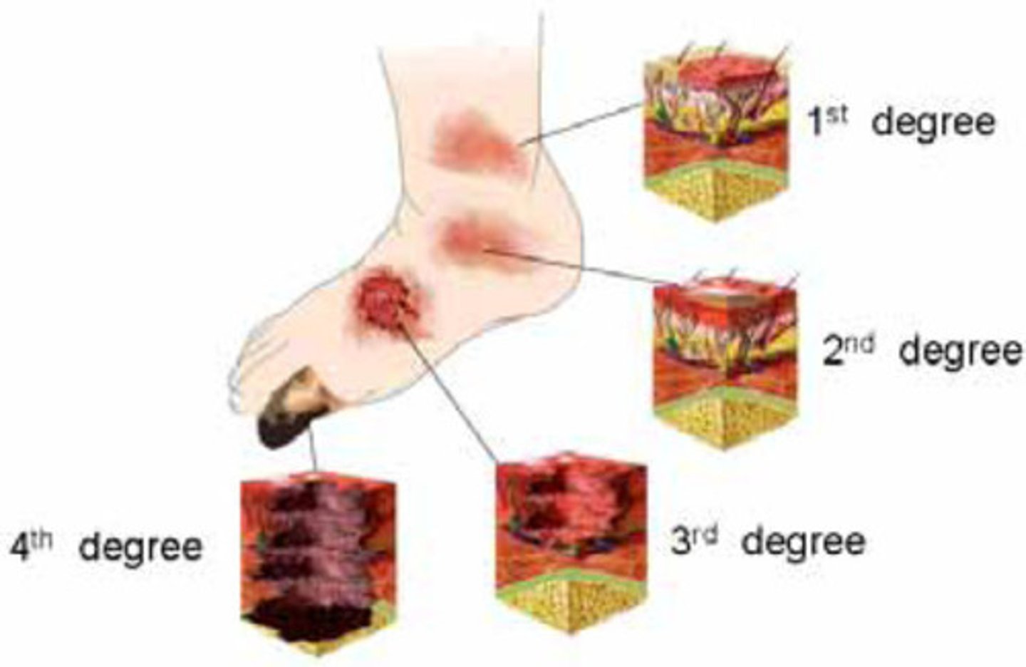<p>1st: minor damage to epidermis (no blister)</p><p>2nd: extends to dermis (blister) PAIN</p><p>3rd: white charred appearance, NO pain!!</p><p>4th: subcutaneous tissue into muscle and bone</p>