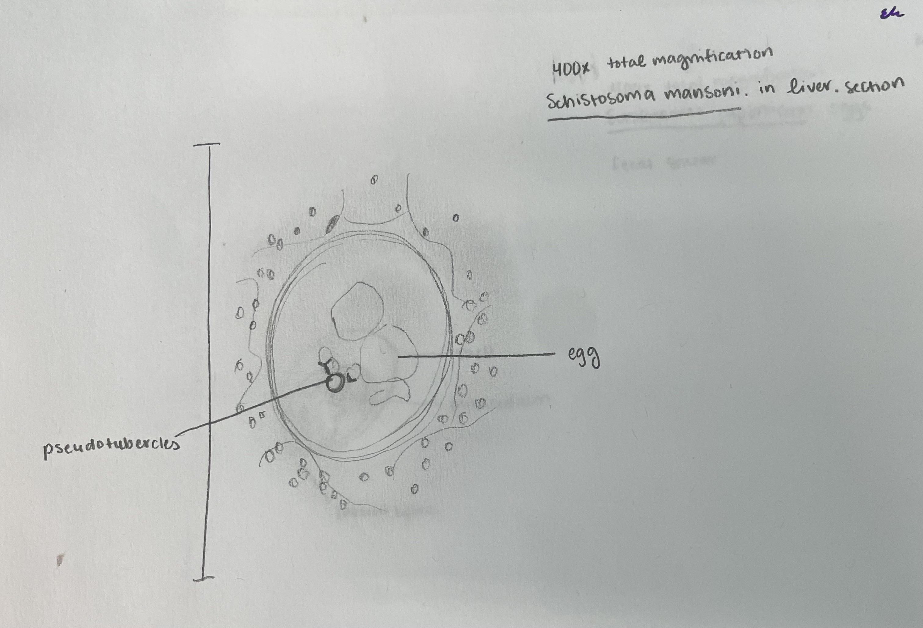 <p>Schistosoma mansoni, in liver. (Phylum Platyhelminthes, Subphylum Neodermata, Class Trematoda, Subclass Digenea, Family Schistosomatidae). Note the pseudotubercles which is a type of granuloma caused by Schistosoma eggs. </p>