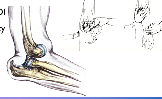 <ul><li><p>Report of extension to flexion + supination MOI </p></li><li><p>Severe pain and disability </p></li><li><p>Bulge behind elbow </p></li><li><p>May have neurovascular symptoms</p></li></ul><p></p>