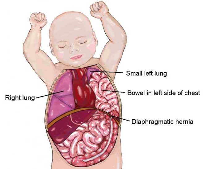 <ol><li><p><span style="color: rgb(217, 41, 41);"><strong>DONT bag mask</strong></span> ventilate (pushes air into stomach!!)</p></li><li><p><span style="color: rgb(36, 179, 80);"><strong>endotracheal intubation</strong></span> immediately!!!!</p></li><li><p><span style="color: rgb(163, 54, 187);"><strong>NG tube</strong></span> (decompress stomach)</p></li><li><p>turn on <span style="color: rgb(235, 127, 38);"><strong>AFFECTED side</strong></span></p></li></ol><p></p>