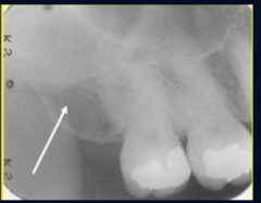 <p>maxillary tuberosity</p>