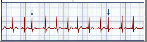 <p>Premature atrial contraction</p><ul><li><p><strong>define</strong></p></li><li><p>p wave (3)</p></li><li><p>QRS (1)</p></li><li><p>could be caused by (10) (5 big ones)</p></li></ul><p></p>