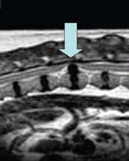 <p>The MRI has confirmed intervertebral disc herniation at T12-T13 with spinal cord compression. The disc material, cord, and epidural fat are all clearly visualized and distinguished from each other.</p><p>The surgical team asks: "Could we have answered the same clinical question with radiography or ultrasound — and if not, why not?"</p><p>The student summarizes the modality limitations established in this session:</p><p>• Radiography: limited soft tissue contrast between cord, disc, and adjacent tissues (all attenuate X-rays similarly)</p><p>• Ultrasound: acoustic shadowing from the vertebral column prevents sound waves from reaching the spinal cord</p><p>The team asks the student to explain exactly what MRI provides that these modalities cannot — and in which specific clinical contexts this advantage is most important.</p><p>Canine thoracolumbar spinal MRI</p><p></p><p><strong>Which statement best explains what MRI provides that radiography and ultrasound cannot for this case — and correctly identifies the clinical contexts where this advantage is most important?</strong></p><p><span>a. MRI provides faster image acquisition than radiography and ultrasound, making it the preferred modality for any emergency evaluation where speed is critical.</span></p><p><span>b. MRI provides superior soft tissue contrast resolution — it distinguishes soft tissue structures with similar physical composition (spinal cord, disc material, epidural fat) that appear identical on radiography and are inaccessible to ultrasound due to acoustic shadowing. This advantage is most important for neurologic disease (brain and spinal cord) and musculoskeletal joint disease (ligaments, cartilage, menisci) where the clinical question requires distinguishing between adjacent soft tissue structures.</span></p><p><span>c. MRI provides better bone detail than radiography because the magnetic field interacts more strongly with the calcium mineral in bone, producing higher signal intensity and clearer cortical margins.</span></p><p><span>d. MRI eliminates the need for anesthesia or sedation compared with radiography and ultrasound, making it safer for compromised patients who cannot tolerate the positioning required for other modalities.</span></p><p></p>