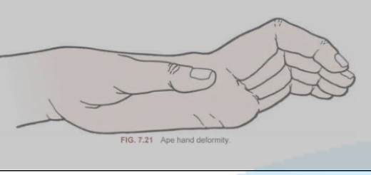 <p>Ape Hand Deformity</p>