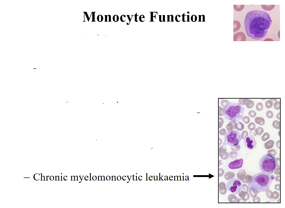 <p>Granule contents:</p><p>- Enzymes: acid phosphatase, esterases</p><p>- Lysozyme, defensins, collagenase</p><p>- Coagulation system proteins</p><p>.</p><p>- Role in phagocytosis and cell killing</p><p>.</p><p>Monocytosis:</p><p>- Chronic infections (e.g. TB)</p><p>- Chronic inflammation</p><p>- Chronic myelomonocytic leukaemia</p><p>.</p><p>- reactive monocytosis occurs in response to chronic infections such as tuberculosis or chronic inflammation</p><p>- so if a patient who has a persistent increase in monocytes and they look normal and the patient has respiratory distress or a respiratory problem or an abnormality on chest Xray we may suggest testing for Tb</p>