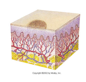 <ul><li><p>flat, non-palpable lesion</p></li><li><p>< 10mm in diameter</p></li><li><p>Well circumscribed change in skin color</p></li></ul><p></p>