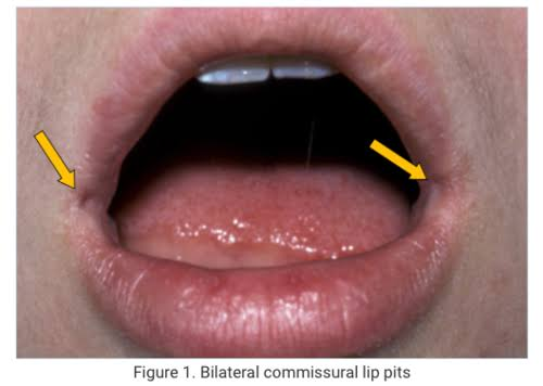 <ul><li><p>Unilateral/bilateral </p></li><li><p>“blind” tracts </p></li></ul><p></p>