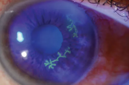 <p><u>Infects cornea</u></p><ul><li><p>Organism: HSV-1 (Herpes Simplex Virus 1)</p></li><li><p>Transmission: Reactivation of latent virus</p></li><li><p>Treatment: <u>Antivirals</u></p></li><li><p>Epidemiology: Can cause blindness</p></li></ul><p></p>