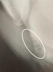 <p>lateral trochelar ridge of femur</p>