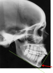 <p>which anatomical landmark:</p><p>- Most anterior point on the mid-sagittal symphysis</p>