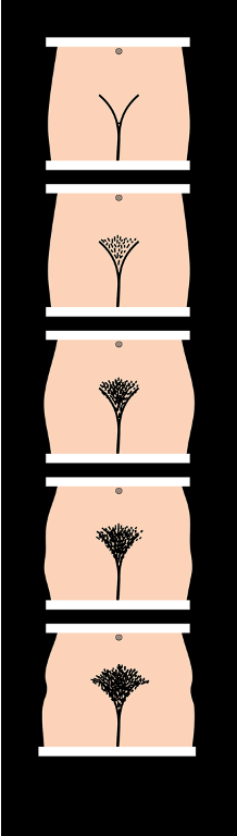 <p>1. prepubertal</p><p>2. straight/fine pubic hair initially on mons pubis; sparse</p><p>3. hair increases in amount and is darker, curlier, more coarse and spreads to labia</p><p>4. adult type hair but limited in amount, no hair on the thighs</p><p>5. complete development (adult genitalia)</p>