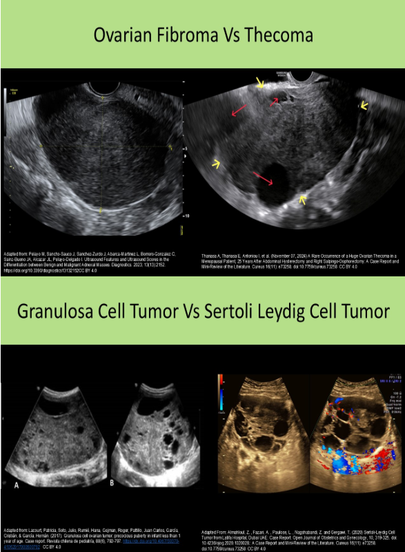 <p>A. fibroma, androblastoma</p><p>Fibromas and thecomas are generally hypoechoic with posterior shadowing. Granulosa cell tumors and androblastomas are generally complex with cystic components.</p>