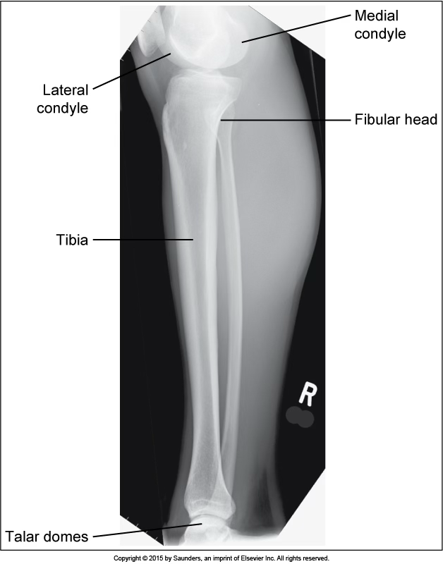 <p>lateral tibfib</p>