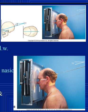 <p>collm of PA AXIAL (CALDWELL) FACIAL BONES</p>