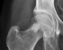 <p>What is this?</p><p>- Any age</p><p>- Asymptomatic</p><p>- Pelvis, but can happen anywhere</p>