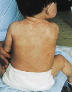 <ul><li><p>enveloped dsDNA, herpesviridae</p></li><li><p><strong><u>exanthem subitum</u></strong> (roseola infantum/6th disease) = maculopapular rash on neck/trunk + high fever (3-4 days); <strong>febrile seizure,</strong> meningitis,<strong> nagayma spots </strong>(uvulopalatoglossal spots)</p></li></ul><p></p>