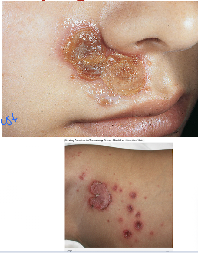 <p>A superficial bacterial skin infection caused by Group B beta-hemolytic streptococci or Staphylococcus aureus.</p>