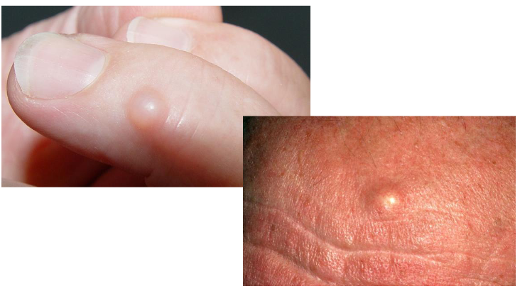 <p>Skin lesion =</p><p>Nodule containing liquid</p>