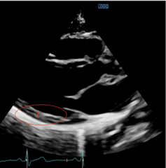 <p>Left Ventricular Posterior Wall (LVPW)</p>