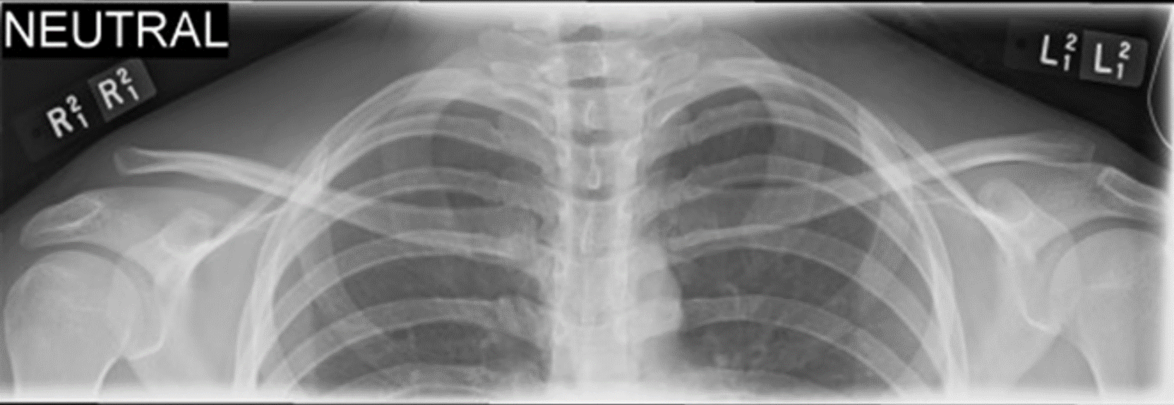 <p>absolute mid-line 2.5cm above jugular notch</p>
