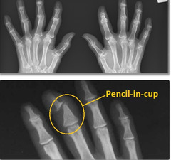<p>pencil in cup deformity</p><p>Asymmetric sacroilitis</p><p>Atypical syndesmophytes</p>