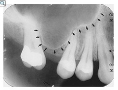 <p>Radiopaque line outlining the maxillary sinus</p>