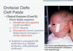 <p>Mandibular Micrognathia, Glossoptosis (tongue backward and downward), U-Shaped Cleft Palate</p>