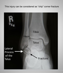<p>Chip fracture</p>