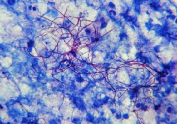 <p>differentiate acid-fast nocardia (bacteria) from other true fungal elements</p>