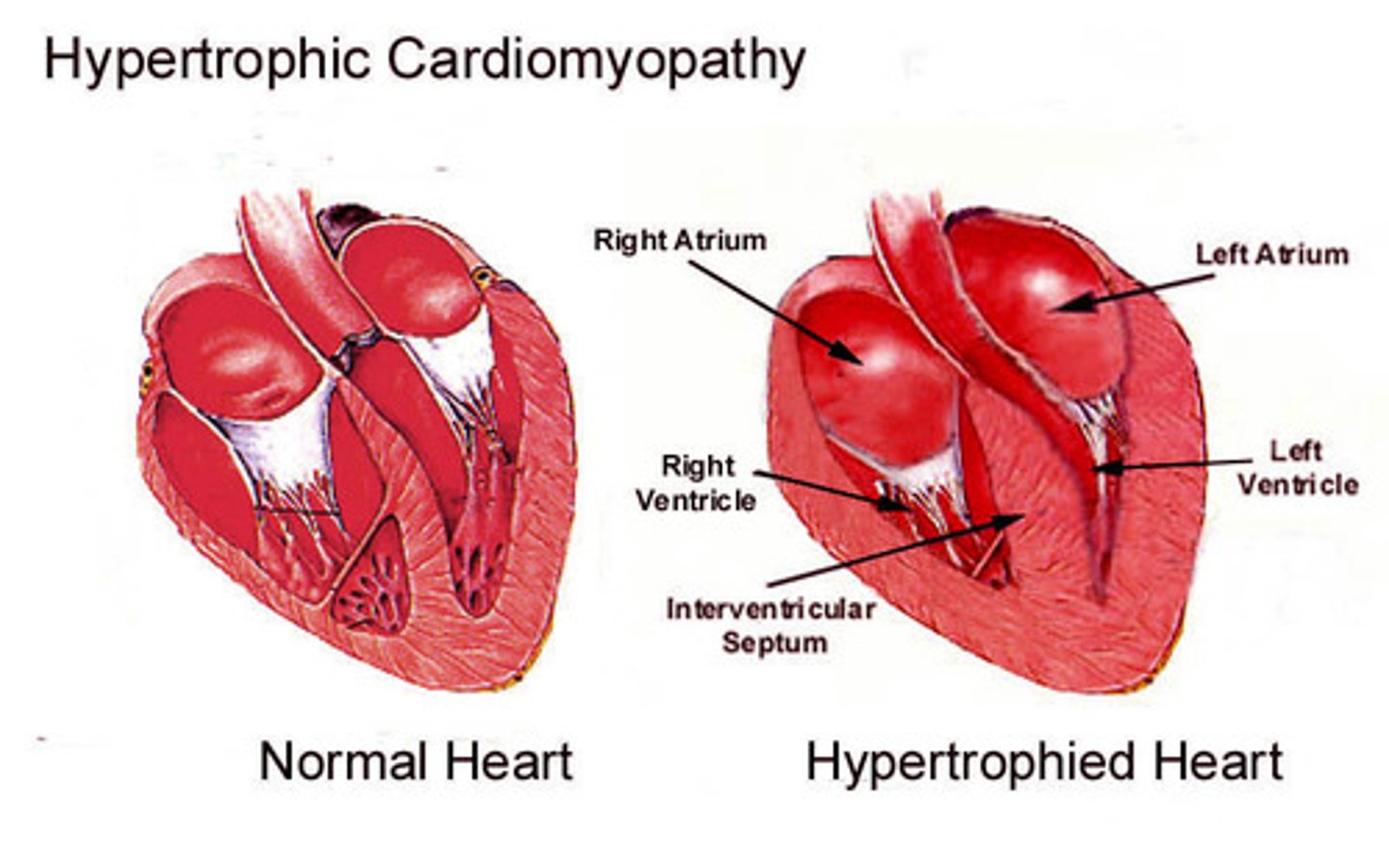 <p>A condition in which the heart muscle becomes abnormally thick and blocks blood flow</p><p>inherited genetic disease caused by mutations in the genes that make proteins in the heart muscle (sarcomeres)</p>
