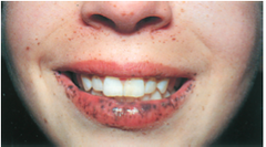 <p>Peutz-Jegher's Syndrome</p>