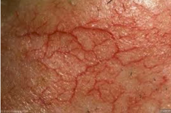 <ul><li><p>Results from secondary skin lesion</p></li><li><p>Dilated, superficial blood vessels</p></li></ul><p></p>