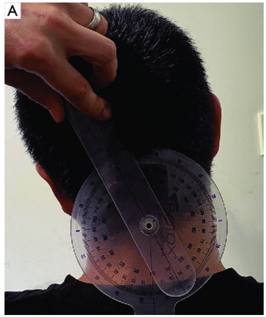 <p>• The goniometer's fulcrum is placed over the spinous process of C7. </p><p>• The stationary arm is aligned with the spinous processes of the thoracic spine (ideally T1). </p><p>• The moving arm is aligned with the dorsal midline of the head.</p>