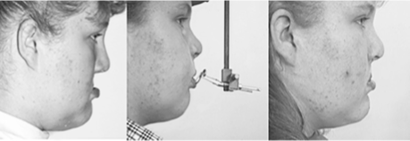 <p>What is this maxillary advancement technique?</p>