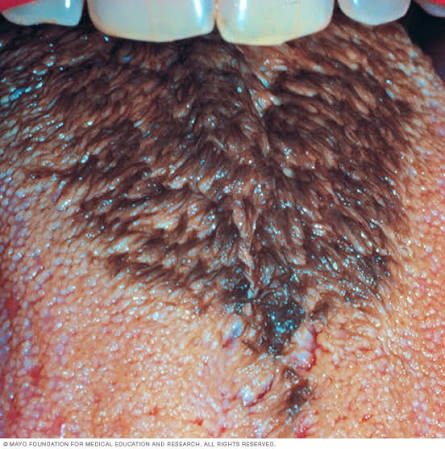 <ul><li><p>Anything that changed the biochemistry of the mouth </p></li><li><p>Elongated filiform papillae </p></li></ul><p></p>