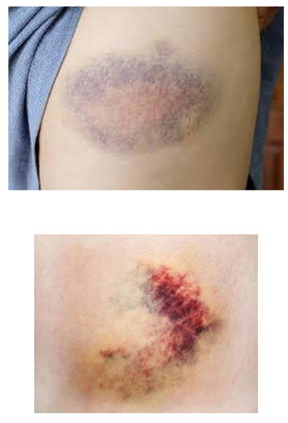<p>What kind of lesion is this?</p>