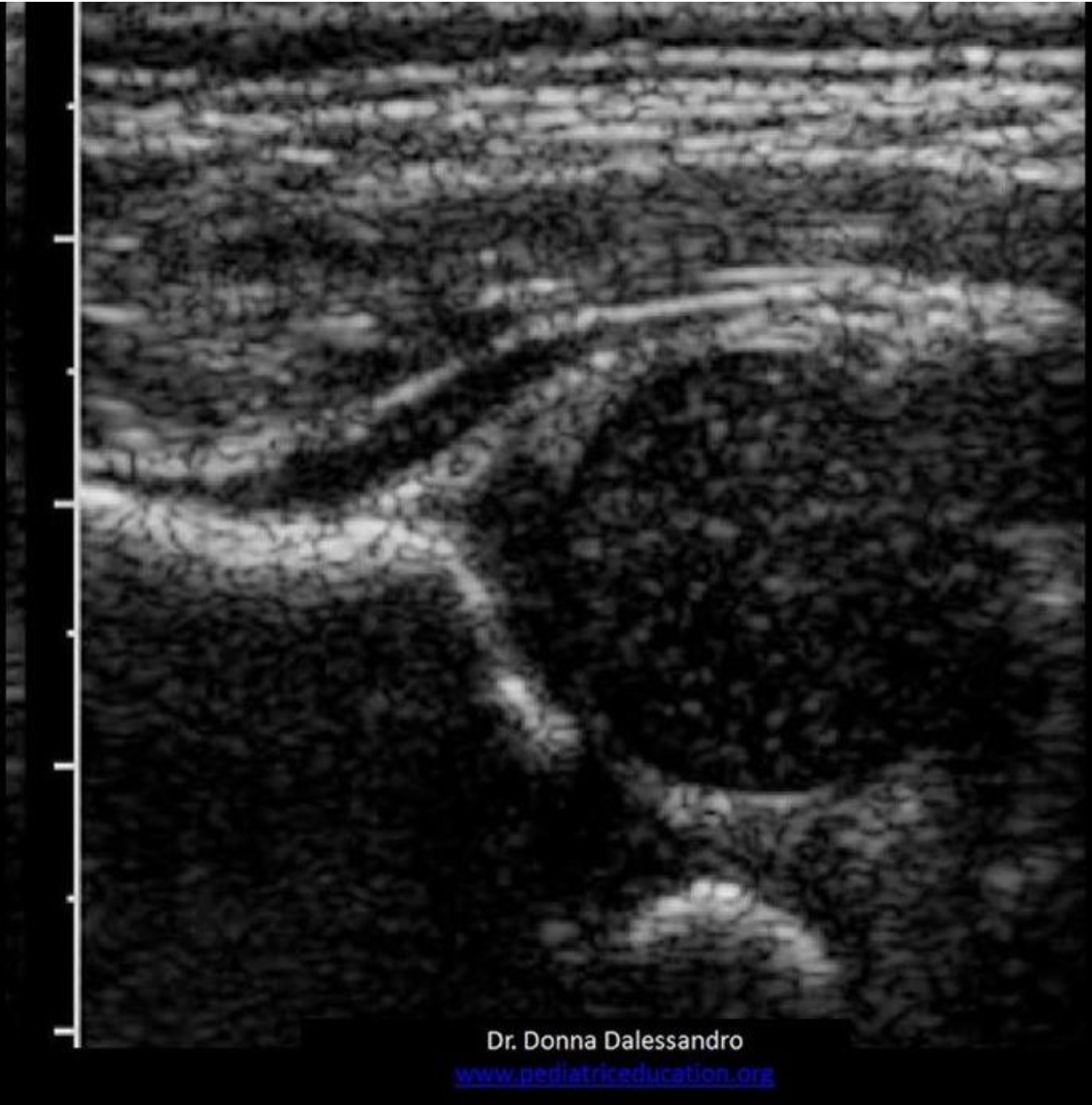 <p>Locate the triradiate cartilage</p>