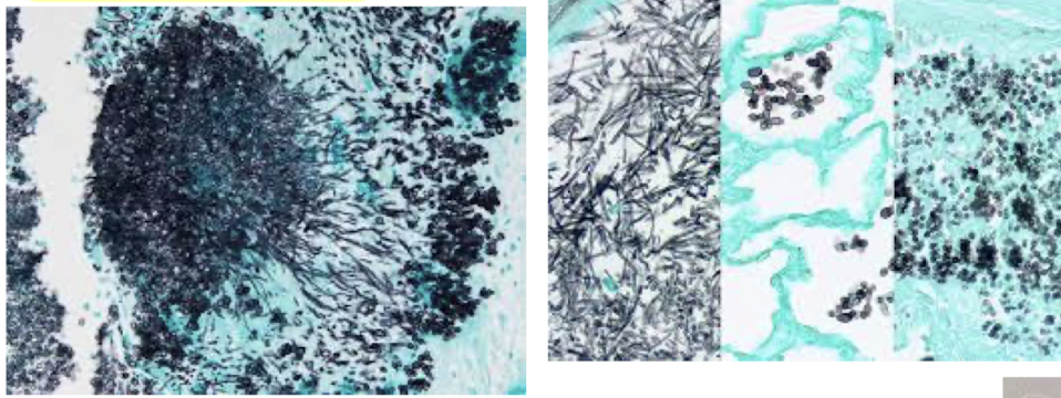 <p>Disease </p>