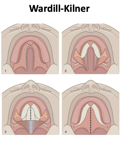<p>Surgery to repair cleft palate by raising two single-based flaps from palate, bringing together, pushed back close to cleft to lengthen palate, improves VP closure</p>