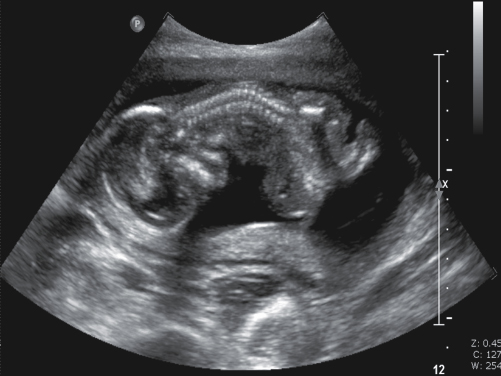 <p>Short or absent umbilical cord</p><p>Marked scoliosis</p><p>Various other anomalies including craniofacial and limb defects</p>