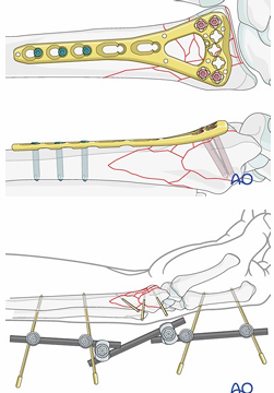 <p>WRIST:</p><p><u>Indications</u>: Displaced or comminuted #’s</p><p>Post Operation: Cast 6 wks, commence AROM and strengthening post cast removal</p><p></p><p>HAND/FINGER: <br>Compression plate simple # + K-wire banding post avulsion #</p>