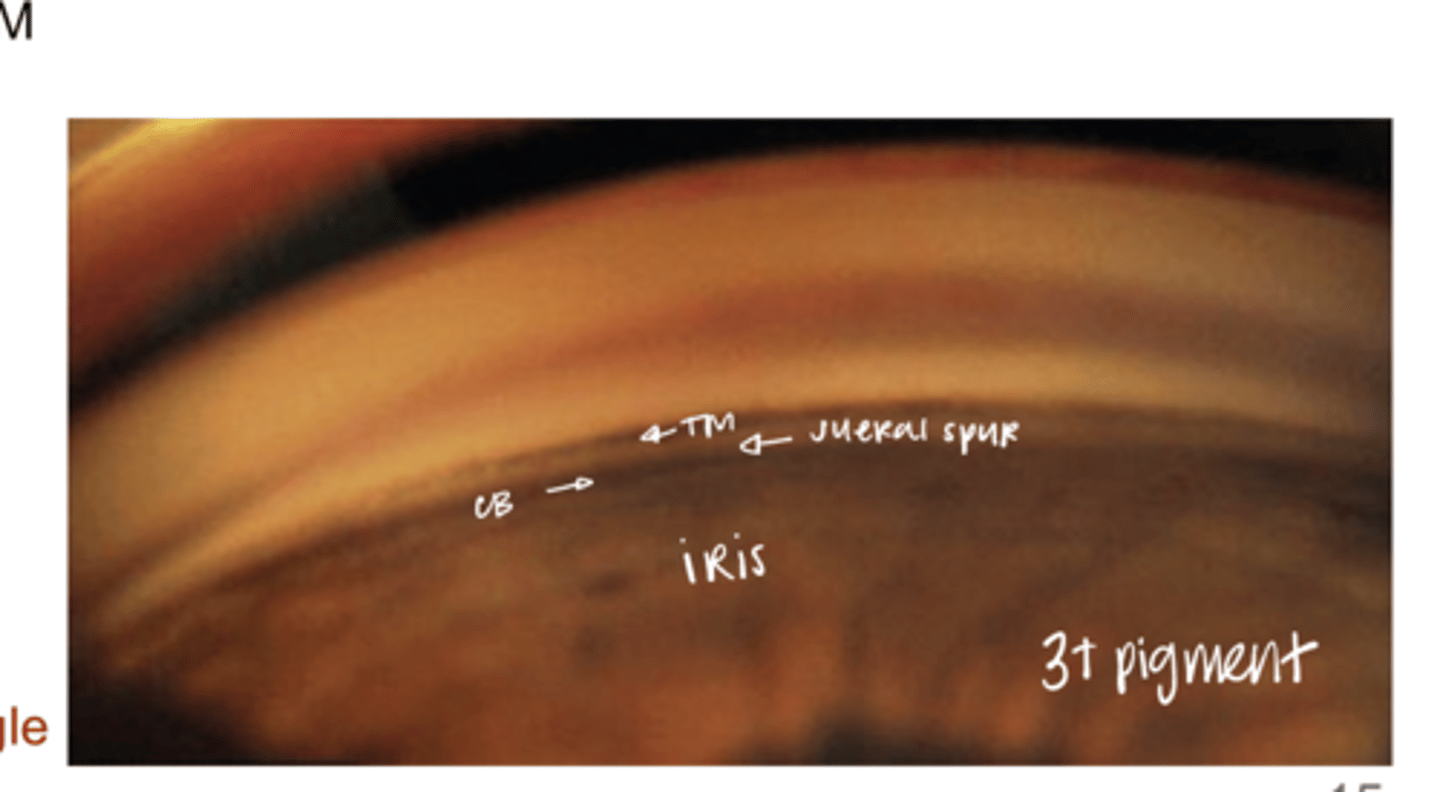 <p>Grade 3+ Pigment in Open Angle (Pic)</p>