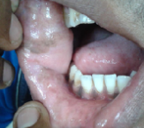 <p><strong>ex:</strong> <span style="color: red;">cigarette smoking</span> → stimulates melanocytes</p><p>increased / abnormal melanin pigmentation in tissues</p>