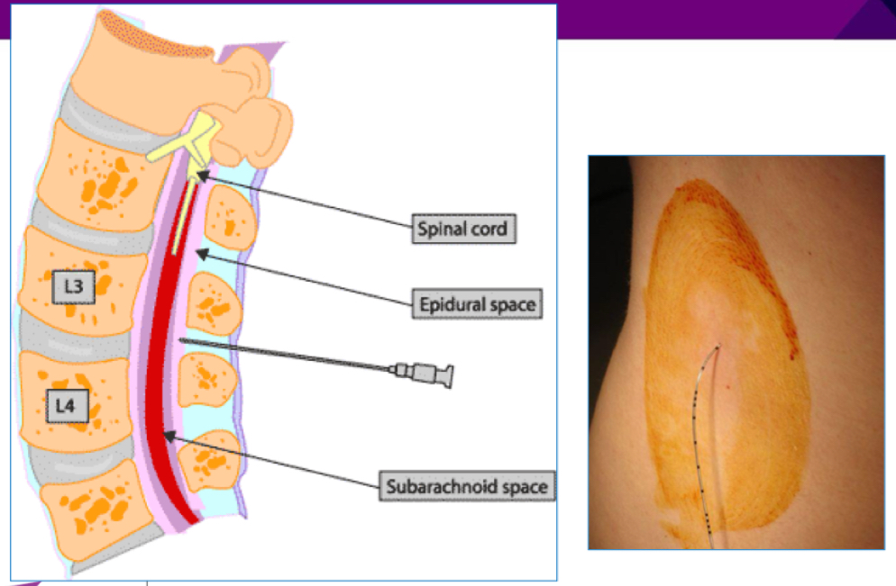 <ul><li><p>Local anaesthetic ± opiate in the space outside the dura (eg bupivacaine + fentanyl)</p></li><li><p>Drugs can selectively block sensation without shutting off motor function entirely</p></li><li><p>Level of analgesia depends on where the catheter is inserted</p></li><li><p>Bonus with continuous background or as a PCA</p></li></ul><p></p>
