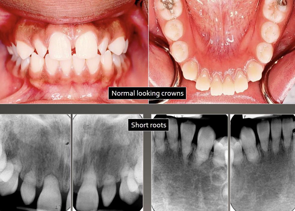<p>4 types, normal clinical crown, short roots, periapical radiolucencies, chevron pulp chambers </p>