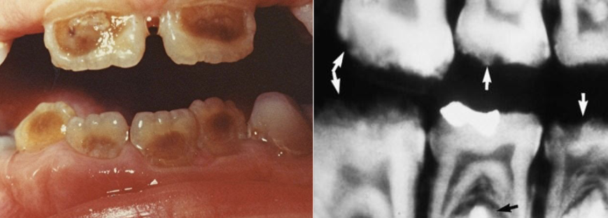 <p>AD, AR, X-linked; both deciduous and permanent dentition are diffusely involved, affects enamel (soft, thin, easily damaged, susceptible to decay), dentin is exposed </p>