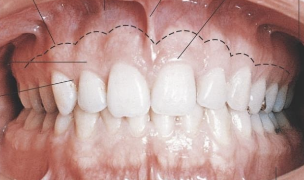 <p>(MGJ) is the anatomical boundary marking the transition between the firm, keratinized attached gingiva and the loose, movable, nonkeratinized alveolar mucosa</p>