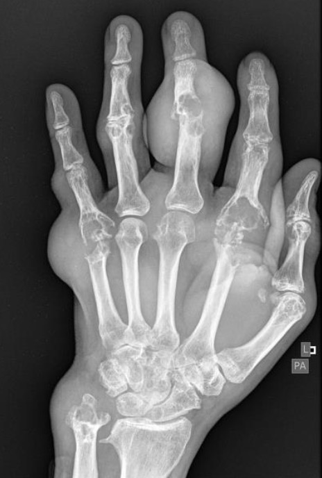 <ul><li><p>Soft tissue swelling</p></li><li><p>Well defined, punched-out erosions (rat bite)</p></li><li><p></p></li></ul><p></p>