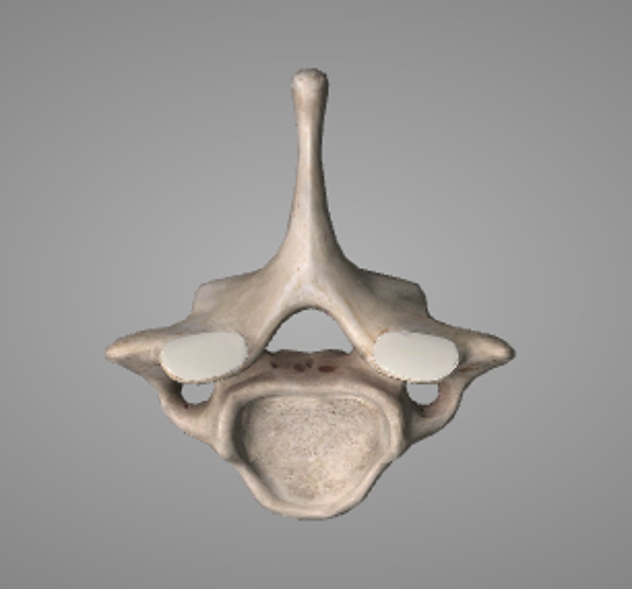 <p>distinctive long and prominent spinous process, which is palpable from the skin surface</p>